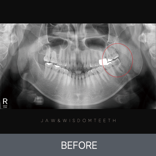 뿌리가 긴 사랑니 발치 CASE