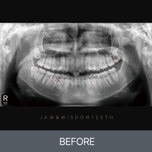 과잉치 및 사랑니발치 CASE