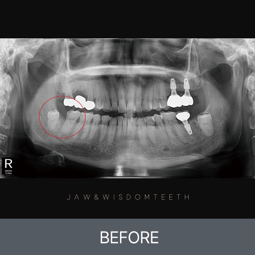 고난이도 사랑니발치 CASE