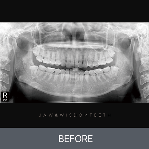 좌측 턱관절 장애 CASE