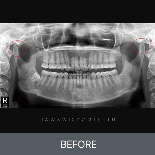 턱관절 내장증 CASE