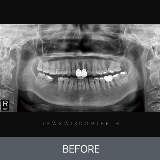 교근 과비대 턱관절 CASE